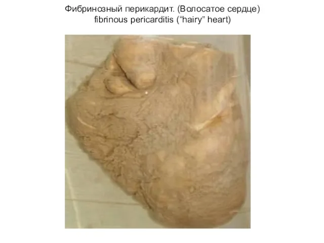 Фибринозный перикардит. (Волосатое сердце) fibrinous pericarditis (“hairy” heart)
