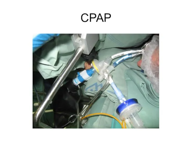 CPAP
