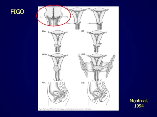 FIGO Montreal, 1994