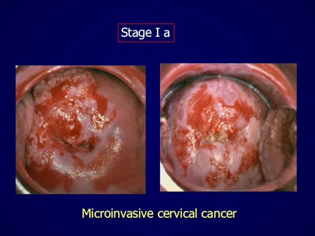 Microinvasive cervical cancer Stage I a