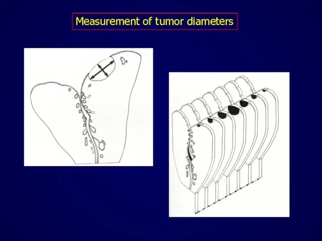 Measurement of tumor diameters