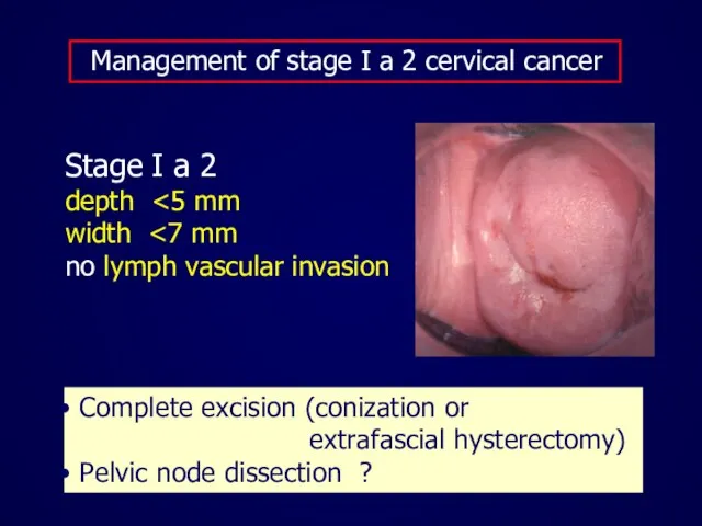 Management of stage I a 2 cervical cancer Stage I a 2