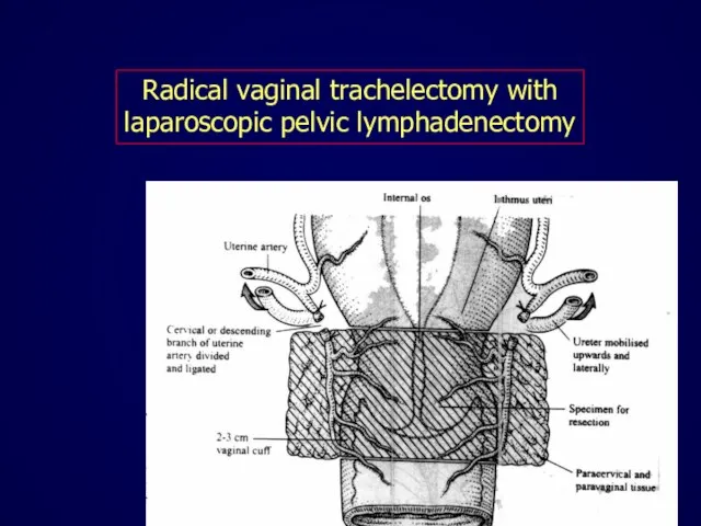 Radical vaginal trachelectomy with laparoscopic pelvic lymphadenectomy