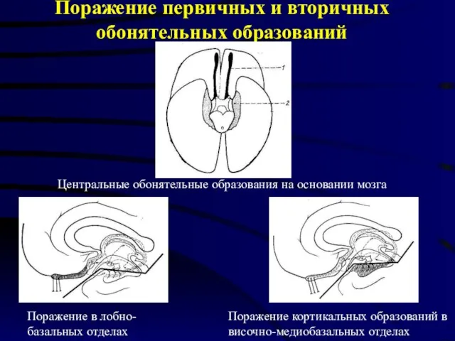 Поражение первичных и вторичных обонятельных образований Поражение в лобно-базальных отделах Поражение кортикальных