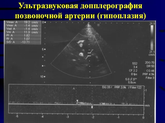 Ультразвуковая допплерография позвоночной артерии (гипоплазия)