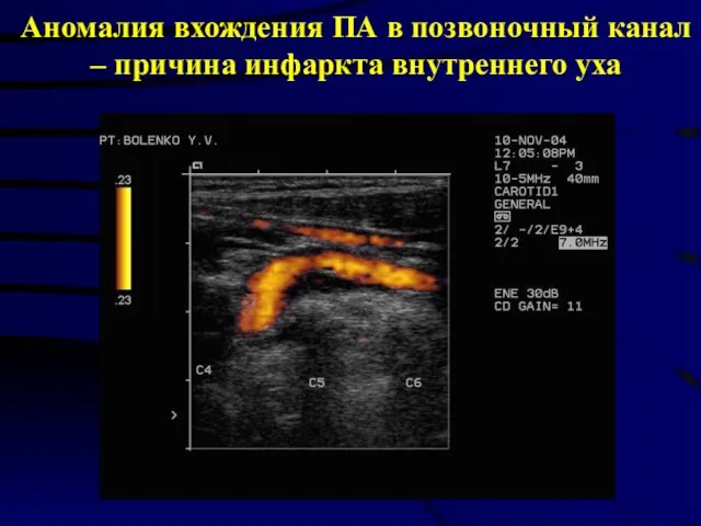 Аномалия вхождения ПА в позвоночный канал – причина инфаркта внутреннего уха