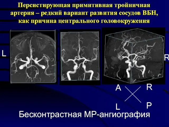 Персистирующая примитивная тройничная артерия – редкий вариант развития сосудов ВБН, как причина