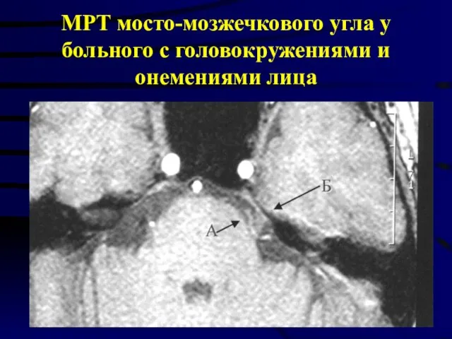 МРТ мосто-мозжечкового угла у больного с головокружениями и онемениями лица