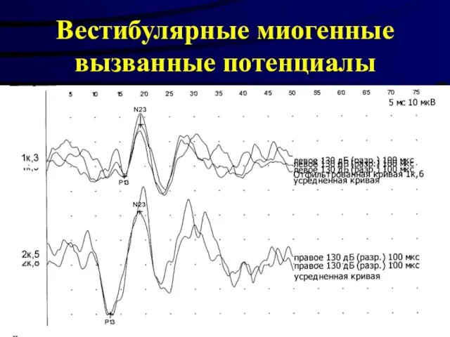 Вестибулярные миогенные вызванные потенциалы