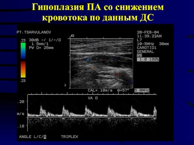 Гипоплазия ПА со снижением кровотока по данным ДС
