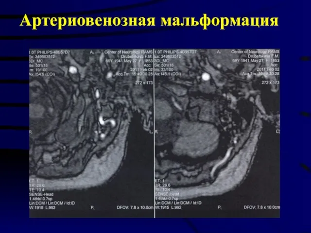 Артериовенозная мальформация