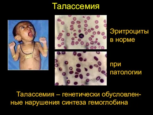 Талассемия Талассемия – генетически обусловлен-ные нарушения синтеза гемоглобина Эритроциты в норме при патологии