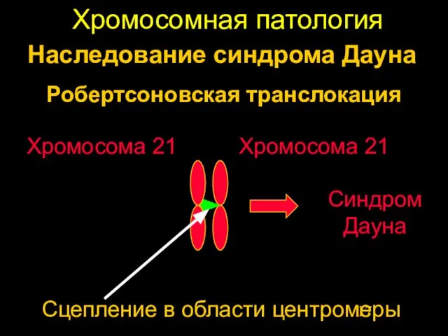 Хромосомная патология Хромосома 21 Хромосома 21 Наследование синдрома Дауна Робертсоновская транслокация Сцепление