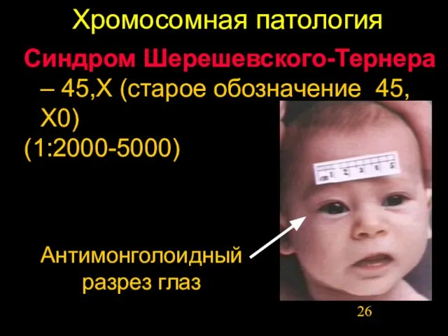 Хромосомная патология Синдром Шерешевского-Тернера – 45,Х (старое обозначение 45,Х0) (1:2000-5000) Антимонголоидный разрез глаз