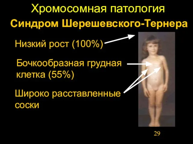 Хромосомная патология Синдром Шерешевского-Тернера Бочкообразная грудная клетка (55%) Низкий рост (100%) Широко расставленные соски
