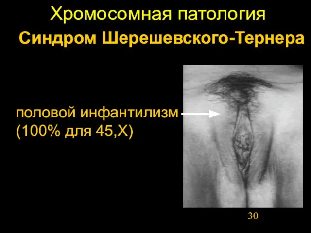 Хромосомная патология Синдром Шерешевского-Тернера половой инфантилизм (100% для 45,Х)