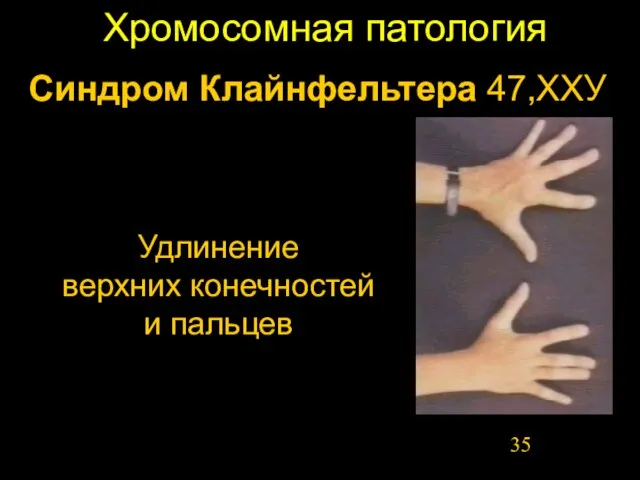 Хромосомная патология Синдром Клайнфельтера 47,ХХУ Удлинение верхних конечностей и пальцев