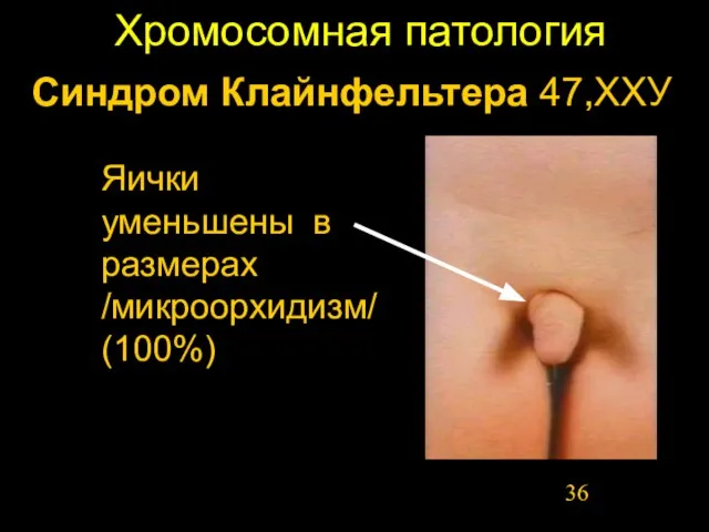 Хромосомная патология Синдром Клайнфельтера 47,ХХУ Яички уменьшены в размерах /микроорхидизм/ (100%)