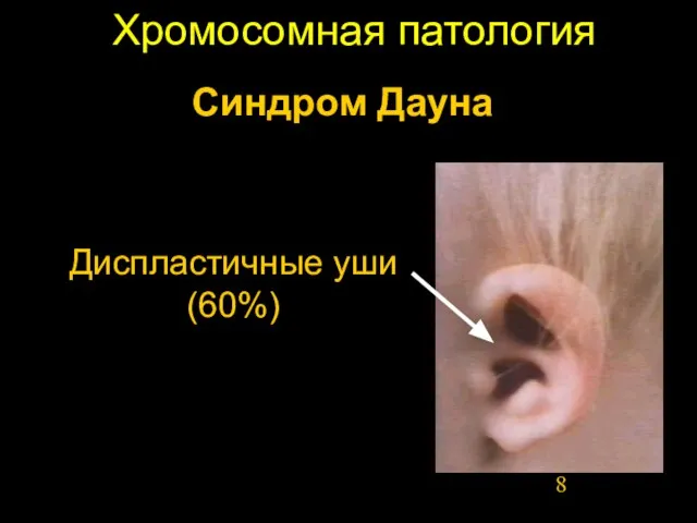 Хромосомная патология Диспластичные уши (60%) Синдром Дауна