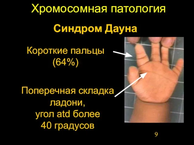 Хромосомная патология Поперечная складка ладони, угол аtd более 40 градусов Синдром Дауна Короткие пальцы (64%)