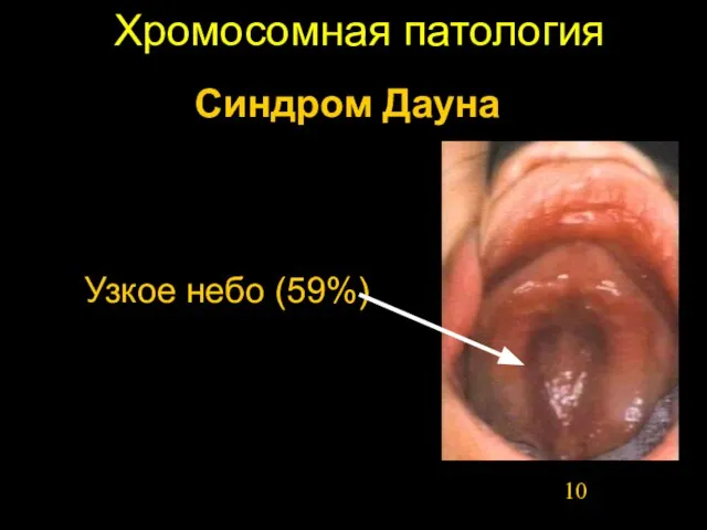 Хромосомная патология Узкое небо (59%) Синдром Дауна