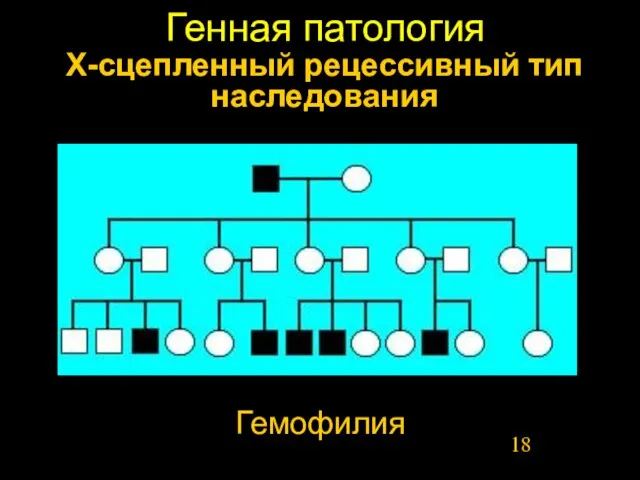 Генная патология Х-сцепленный рецессивный тип наследования Гемофилия