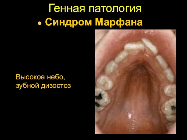 Генная патология Синдром Марфана Высокое небо, зубной дизостоз
