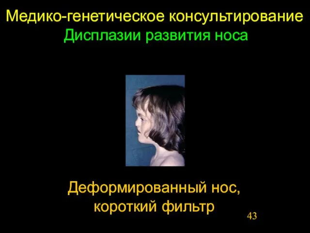 Медико-генетическое консультирование Дисплазии развития носа Деформированный нос, короткий фильтр