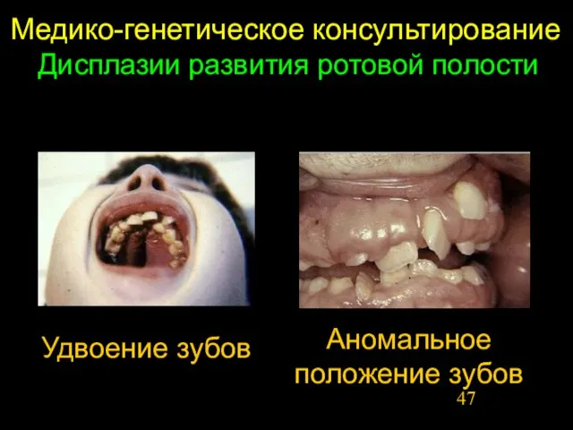 Медико-генетическое консультирование Дисплазии развития ротовой полости Удвоение зубов Аномальное положение зубов