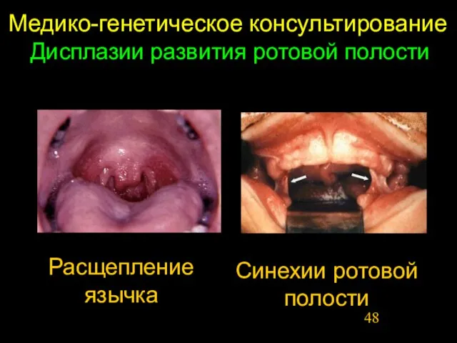 Медико-генетическое консультирование Дисплазии развития ротовой полости Расщепление язычка Синехии ротовой полости