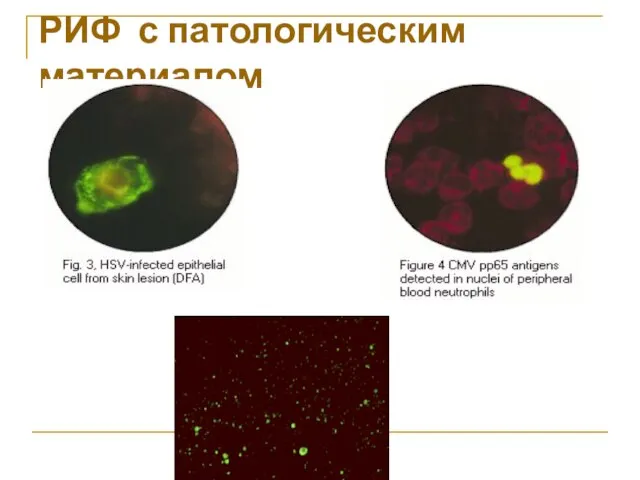 РИФ с патологическим материалом