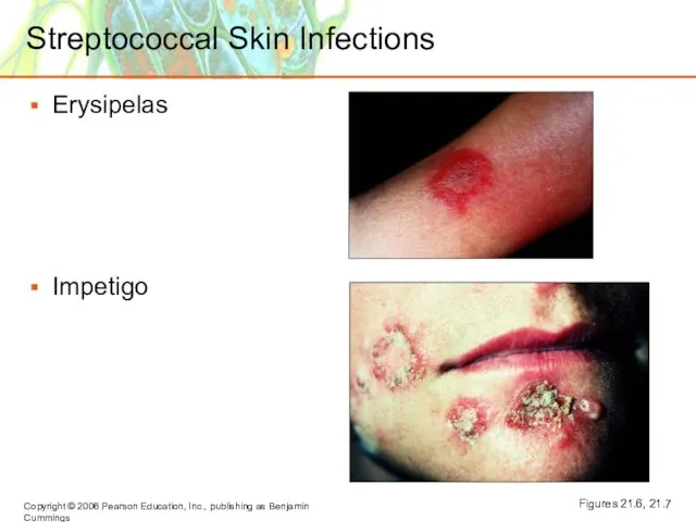 Streptococcal Skin Infections Erysipelas Impetigo Figures 21.6, 21.7