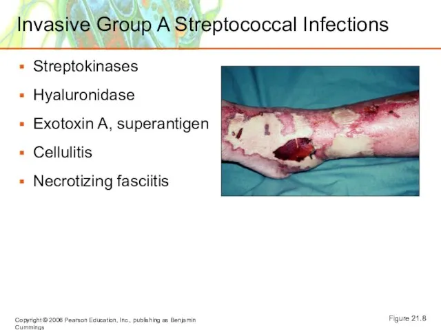 Invasive Group A Streptococcal Infections Streptokinases Hyaluronidase Exotoxin A, superantigen Cellulitis Necrotizing fasciitis Figure 21.8