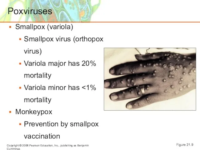 Poxviruses Smallpox (variola) Smallpox virus (orthopox virus) Variola major has 20% mortality