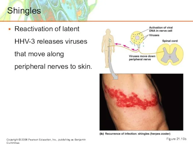 Shingles Reactivation of latent HHV-3 releases viruses that move along peripheral nerves to skin. Figure 21.10b