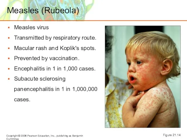 Measles (Rubeola) Measles virus Transmitted by respiratory route. Macular rash and Koplik's