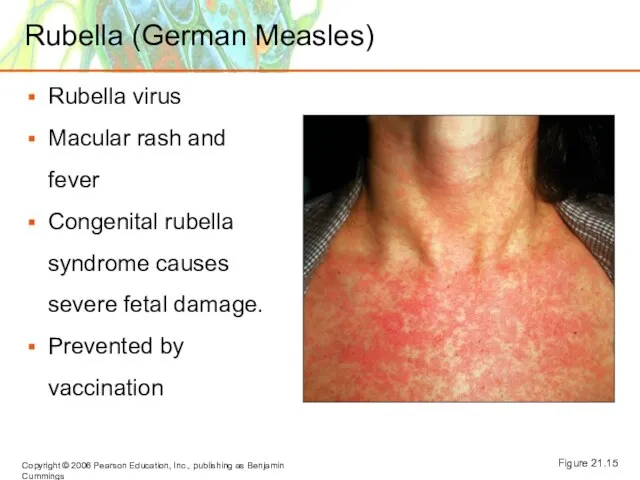 Rubella (German Measles) Rubella virus Macular rash and fever Congenital rubella syndrome