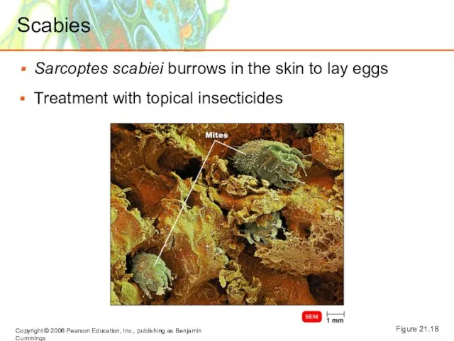 Scabies Sarcoptes scabiei burrows in the skin to lay eggs Treatment with topical insecticides Figure 21.18