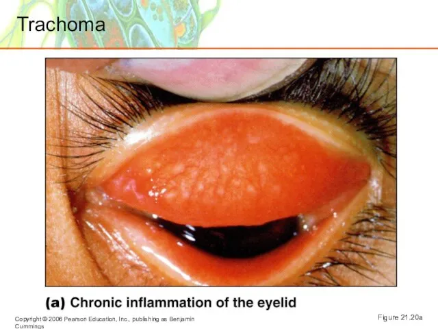 Figure 21.20a Trachoma