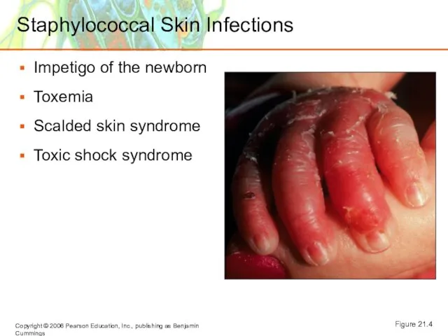 Staphylococcal Skin Infections Impetigo of the newborn Toxemia Scalded skin syndrome Toxic shock syndrome Figure 21.4