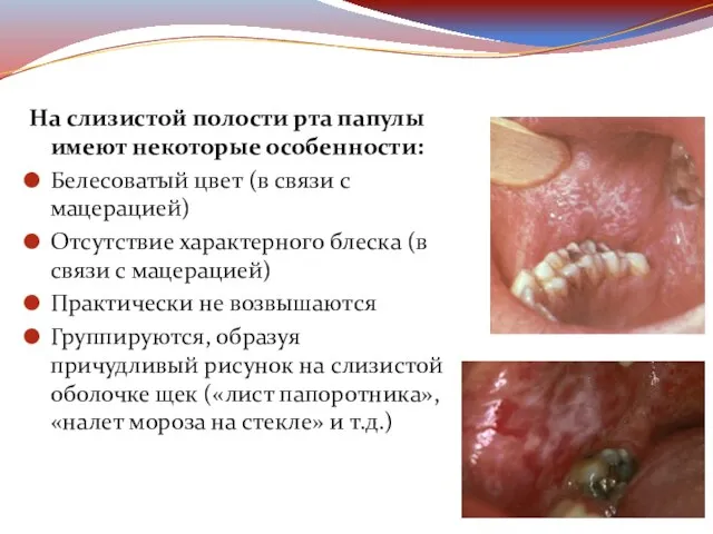 На слизистой полости рта папулы имеют некоторые особенности: Белесоватый цвет (в связи