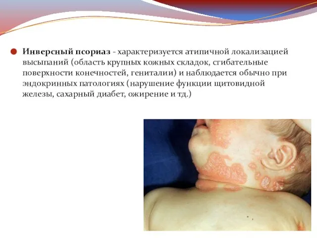 Инверсный псориаз - характеризуется атипичной локализацией высыпаний (область крупных кожных складок, сгибательные