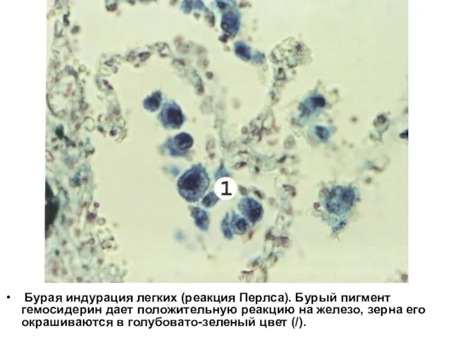 Бурая индурация легких (реакция Перлса). Бурый пигмент гемосидерин дает положительную реакцию на
