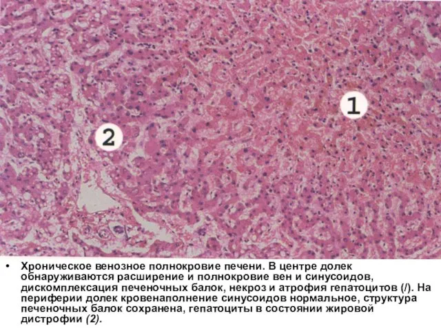 Хроническое венозное полнокровие печени. В центре долек обнаруживаются расширение и полнокровие вен