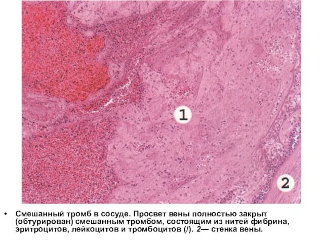 Смешанный тромб в сосуде. Просвет вены полностью закрыт (обтурирован) смешанным тромбом, состоящим