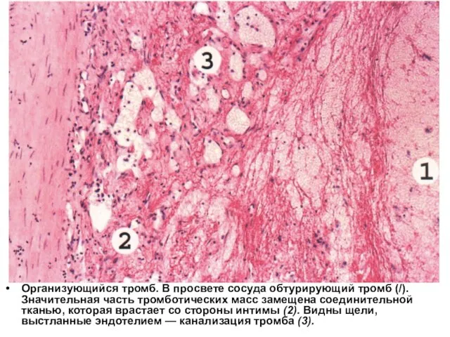 Организующийся тромб. В просвете сосуда обтурирующий тромб (/). Значительная часть тромботических масс