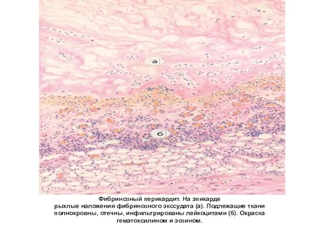 Фибринозный перикардит. На эпикарде рыхлые наложения фибринозного экссудата (а). Подлежащие ткани полнокровны,