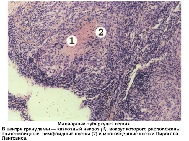 Милиарный туберкулез легких. В центре гранулемы — казеозный некроз (1), вокруг которого
