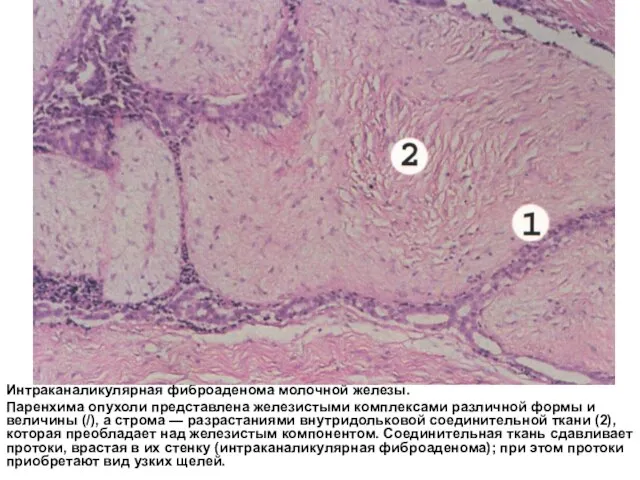 Интраканаликулярная фиброаденома молочной железы. Паренхима опухоли представлена железистыми комплексами различной формы и