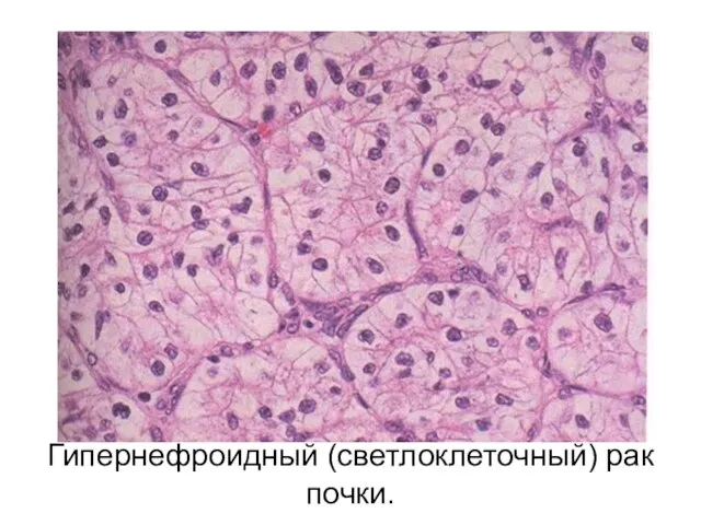 Гипернефроидный (светлоклеточный) рак почки.